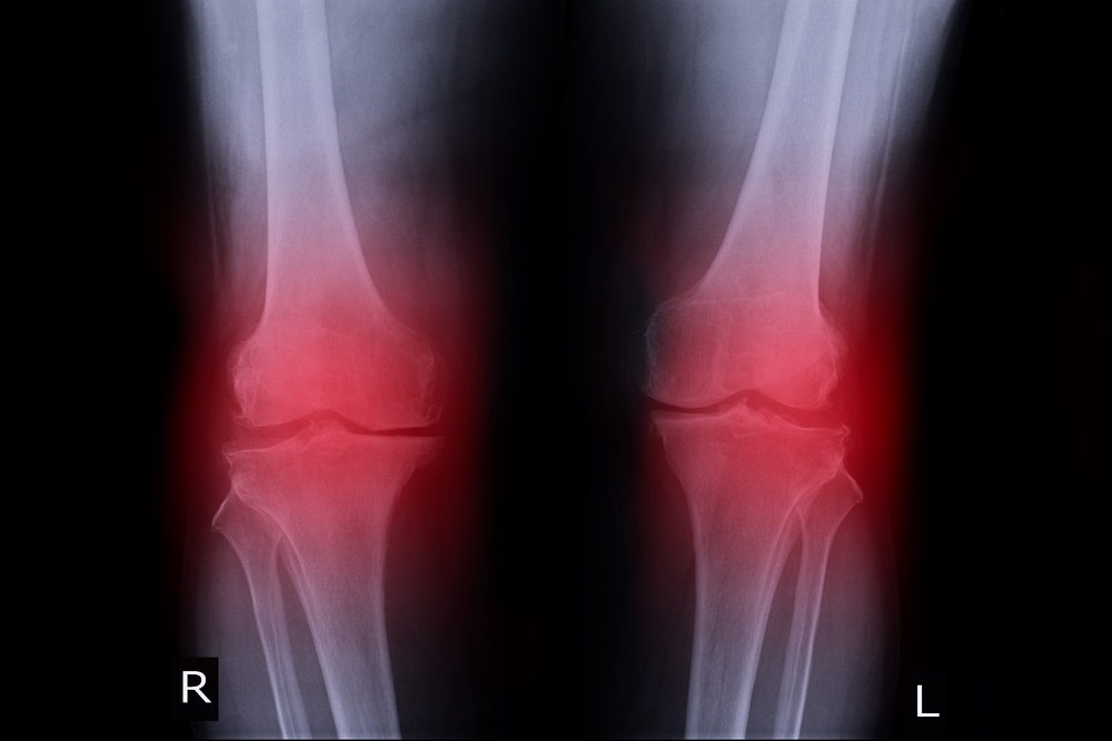 What Are 4 Causes Of Knee Pain