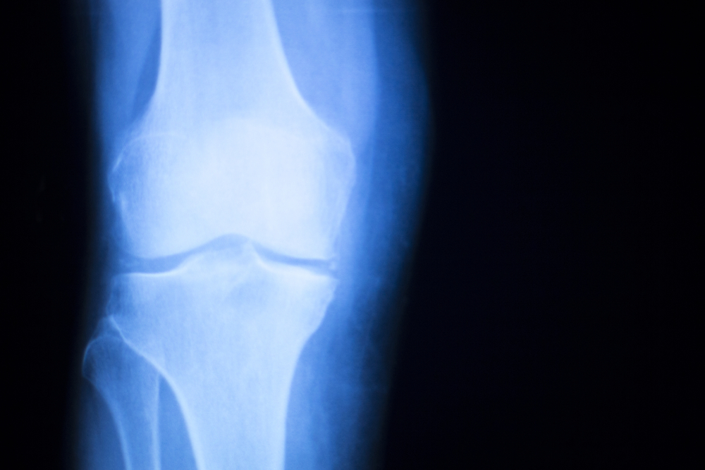 Does Anything Restore Knee Cartilage?