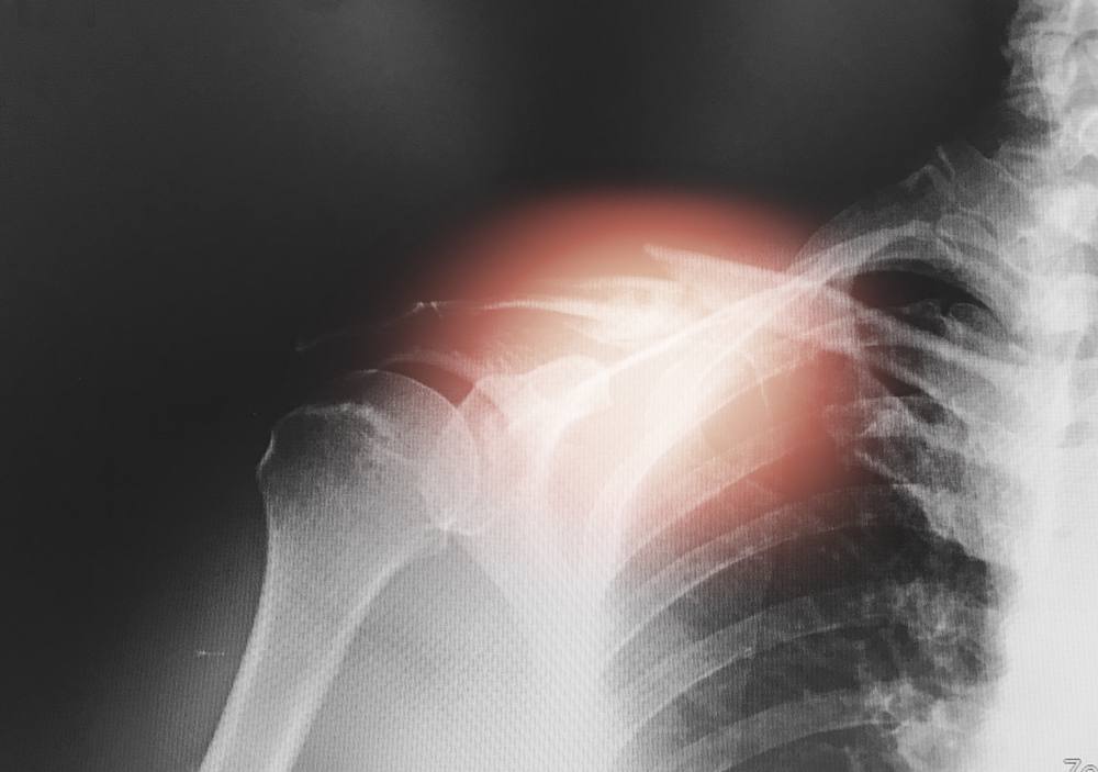 Does Rotator Cuff Pain Radiate Down The Arm?