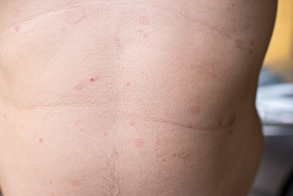 What Is The Common Infection From Jiu-jitsu?