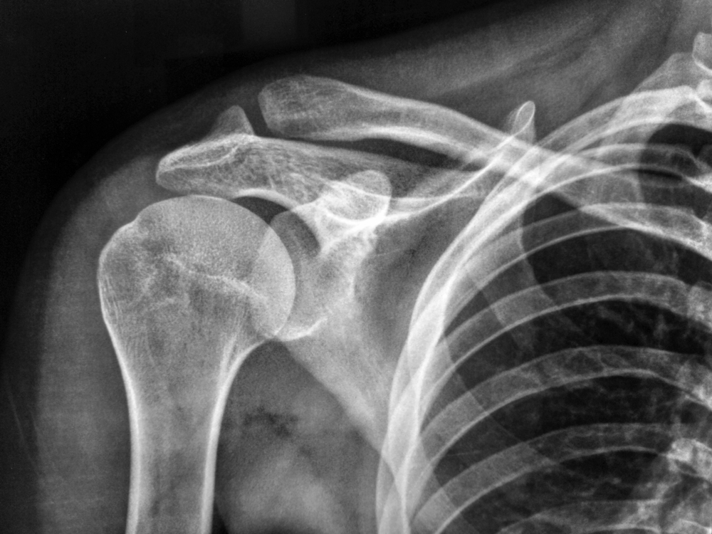 What Makes Rotator Cuff Worse