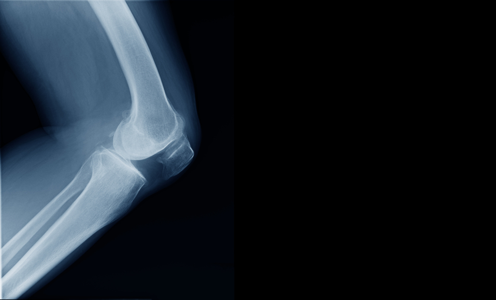 Can An X-ray Show Knee Pain?