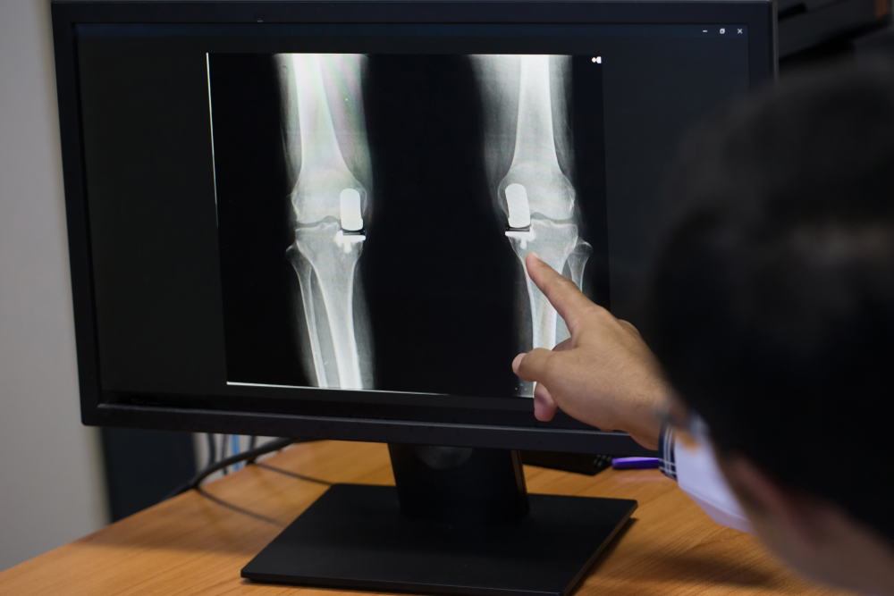 What Are The Restrictions After ACL Repair?