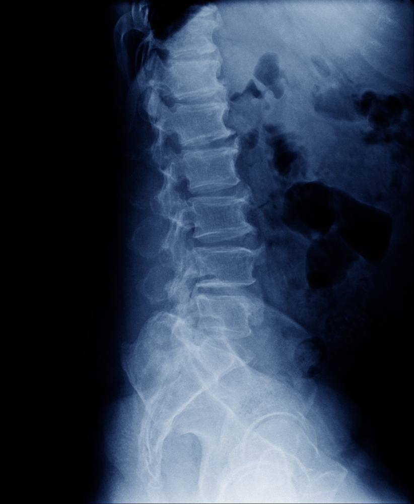 What Can Physical Therapy Do For Spinal Stenosis?