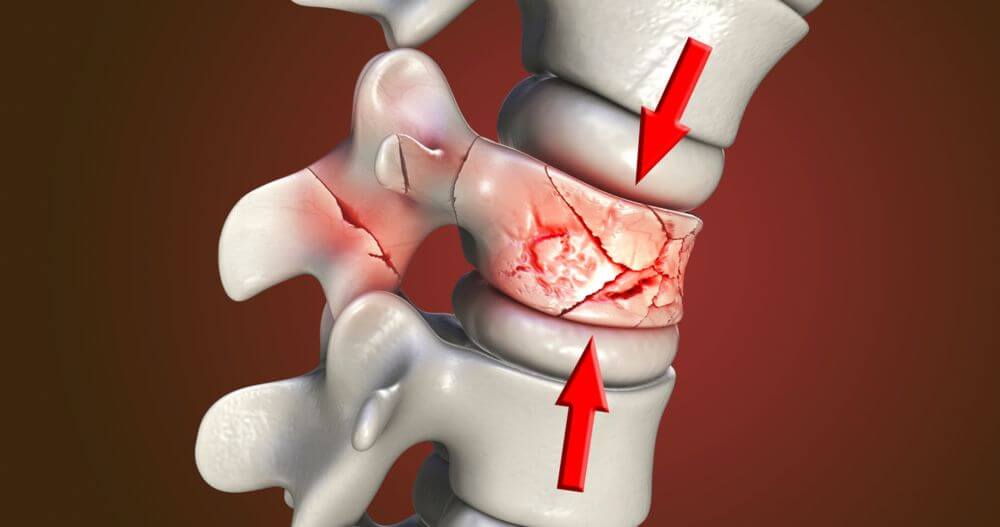 Compression Fracture physical therapy