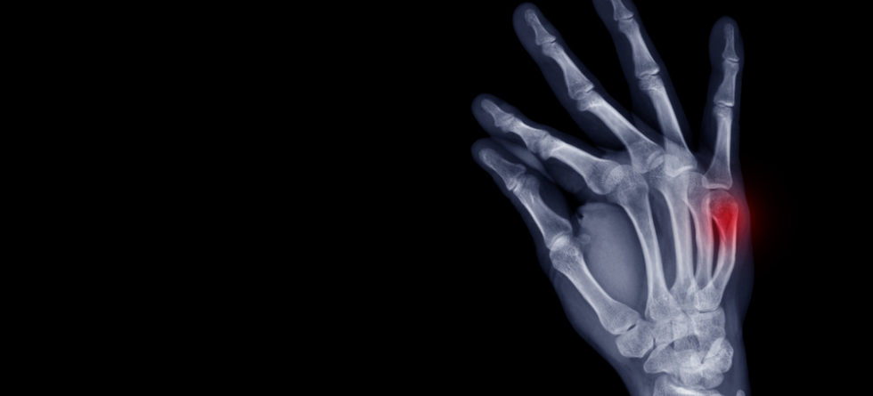 Can A Boxer's Fracture Heal Wrong?