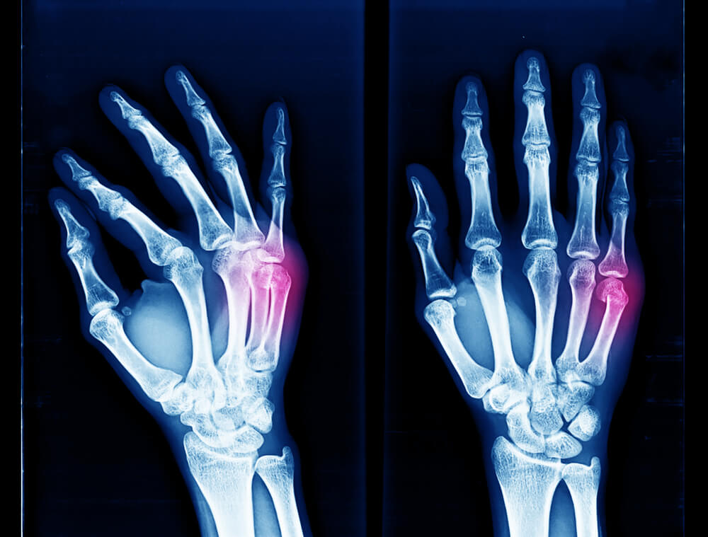 why does my boxers fracture still hurt