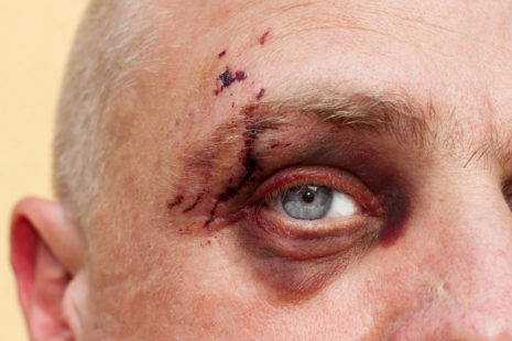 How Do You Treat A Boxing Hematoma?