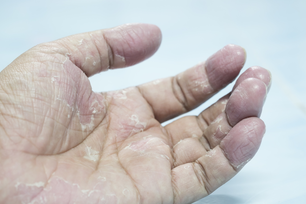 How Do Gymnasts Heal Ripped Hands?