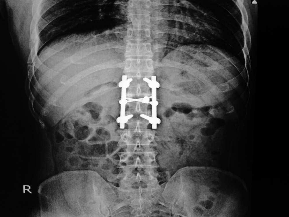 How Do You Realign Your Spine?