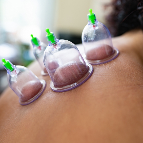 cupping-Physical-Therapy-by-Phoenix-Springfield-MO