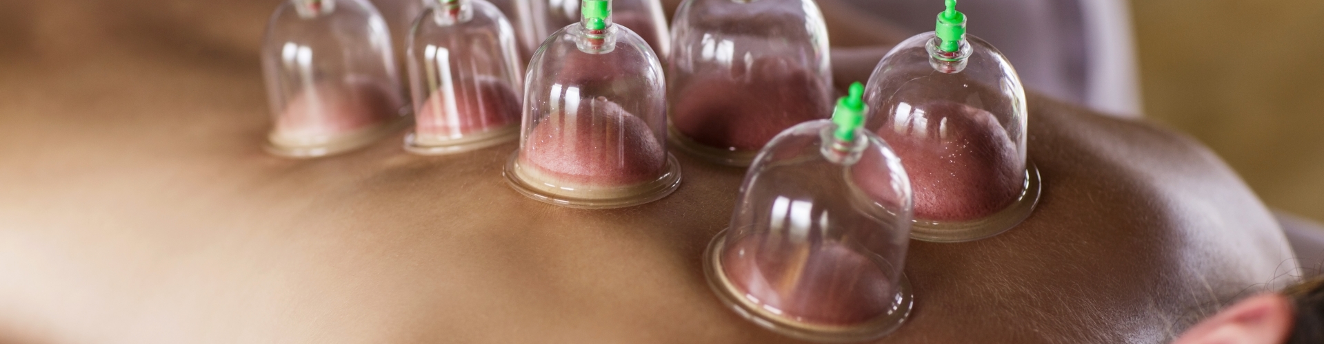 cupping-Physical-Therapy-by-Phoenix-Springfield-MO
