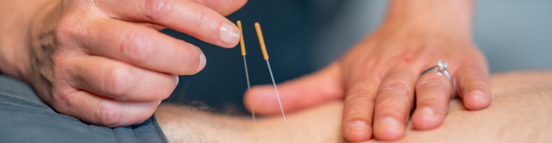 dry-needling-Physical-Therapy-by-Phoenix-Springfield-MO